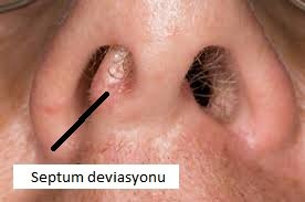 septum deviasyonu